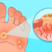   Weary of Warts?